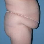 Abdominoplasty in Phoenix Before Photos Case 2