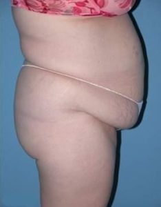 Abdominoplasty in Phoenix Before Photos Case 2