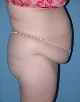 Abdominoplasty in Phoenix Before Photos Case 2