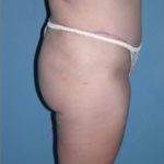 Abdominoplasty in Phoenix After Photos Case 2