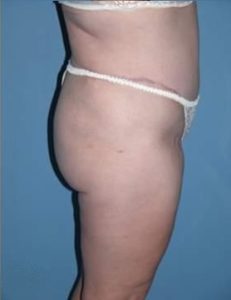 Abdominoplasty in Phoenix After Photos Case 2