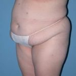 Abdominoplasty in Phoenix Before Photos Case 2