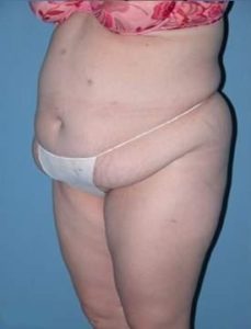 Abdominoplasty in Phoenix Before Photos Case 2