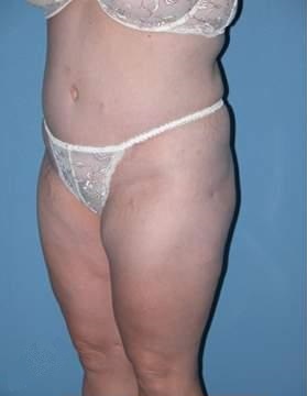 Abdominoplasty in Phoenix After Photos Case 2