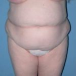 Phoenix Arizona Tummy Tuck Case 9 Before Photos