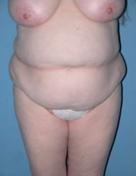 Phoenix Arizona Tummy Tuck Case 9 Before Photos