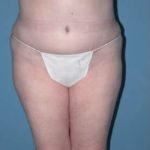 Phoenix Arizona Tummy Tuck Case 9 After Photos