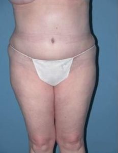 Phoenix Arizona Tummy Tuck Case 9 After Photos