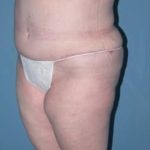 Phoenix Arizona Tummy Tuck Case 9 After Photos