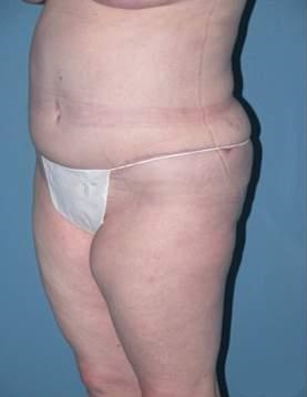 Phoenix Arizona Tummy Tuck Case 9 After Photos