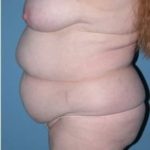 Phoenix Arizona Tummy Tuck Case 9 Before Photos