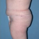 Phoenix Arizona Tummy Tuck Case 9 After Photos