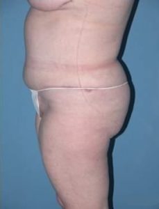 Phoenix Arizona Tummy Tuck Case 9 After Photos