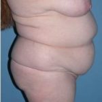 Phoenix Arizona Tummy Tuck Case 9 Before Photos