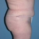 Phoenix Arizona Tummy Tuck Case 9 After Photos