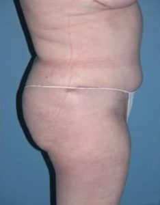 Phoenix Arizona Tummy Tuck Case 9 After Photos