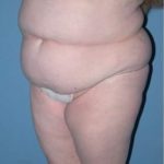 Phoenix Arizona Tummy Tuck Case 9 Before Photos