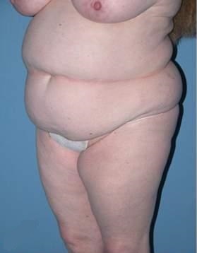 Phoenix Arizona Tummy Tuck Case 9 Before Photos