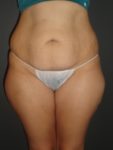 Tummy Tuck Before