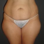 Abdominoplasty Case 10 in Scottsdale Arizona Before Photos