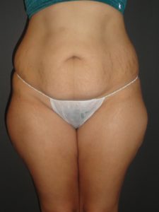 Abdominoplasty Case 10 in Scottsdale Arizona Before Photos