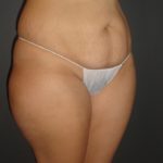 Abdominoplasty Case 10 in Scottsdale Arizona Before Photos