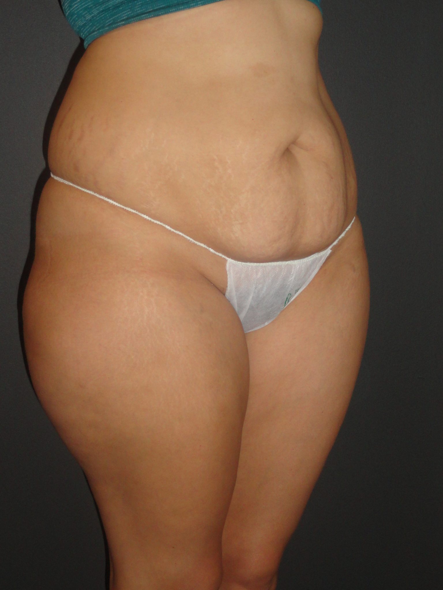 Abdominoplasty Case 10 in Scottsdale Arizona Before Photos