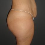 Abdominoplasty Case 10 in Scottsdale Arizona Before Photos