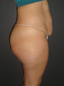 Abdominoplasty Case 10 in Scottsdale Arizona Before Photos