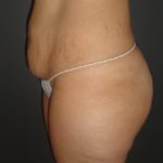 Abdominoplasty Case 10 in Scottsdale Arizona Before Photos