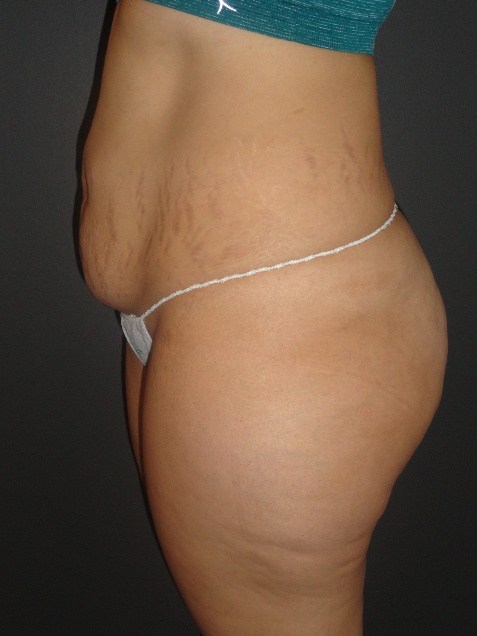 Abdominoplasty Case 10 in Scottsdale Arizona Before Photos