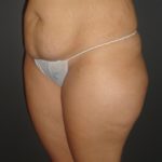 Abdominoplasty Case 10 in Scottsdale Arizona Before Photos