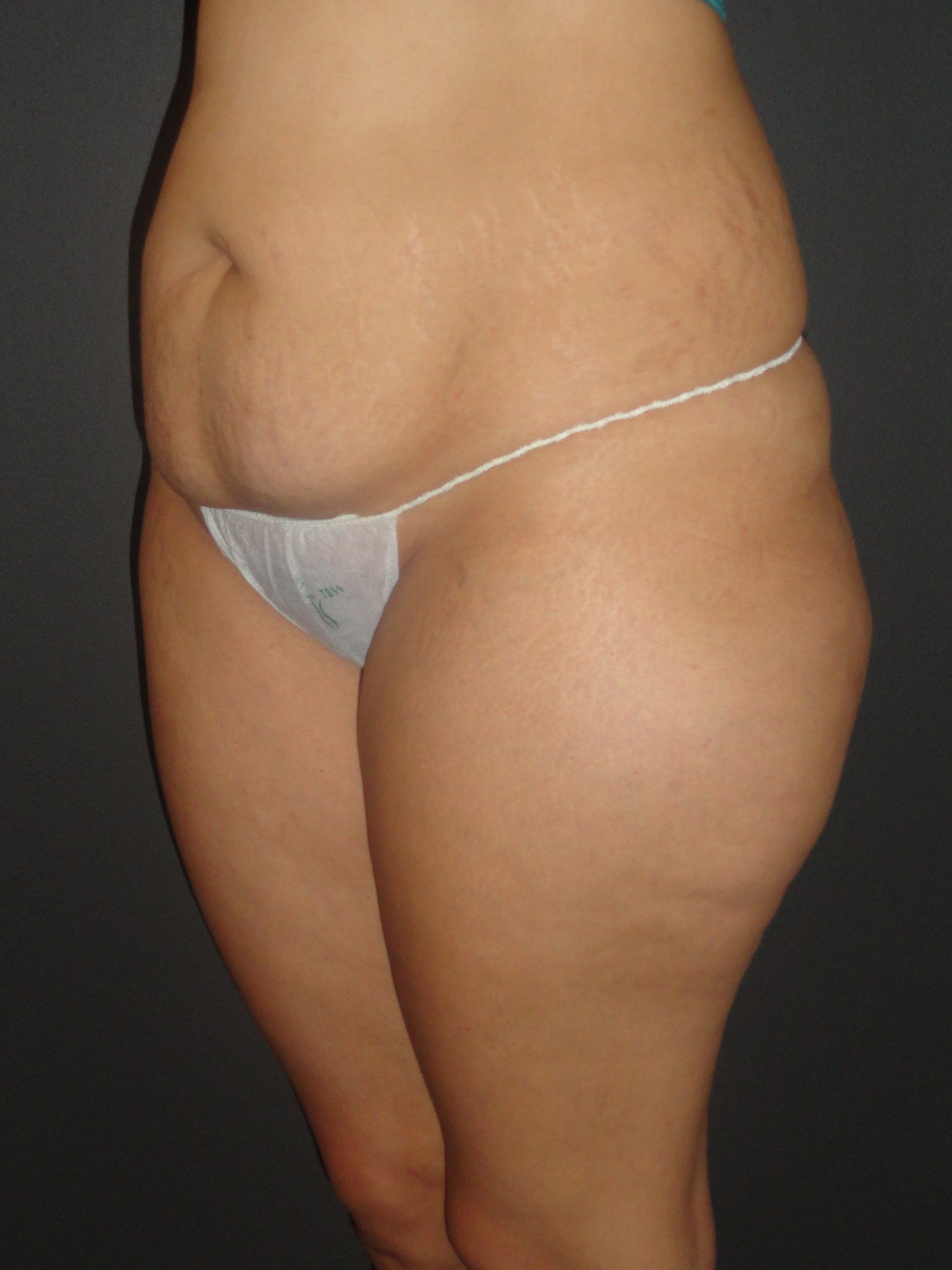 Abdominoplasty Case 10 in Scottsdale Arizona Before Photos