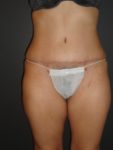 Tummy Tuck After