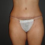 Abdominoplasty Case 10 in Scottsdale Arizona After Photos