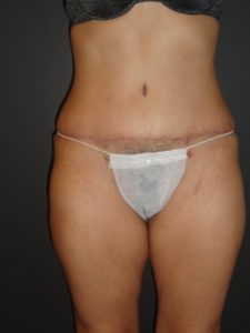 Abdominoplasty Case 10 in Scottsdale Arizona After Photos