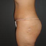 Abdominoplasty Case 10 in Scottsdale Arizona After Photos