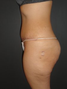 Abdominoplasty Case 10 in Scottsdale Arizona After Photos