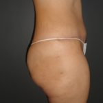 Abdominoplasty Case 10 in Scottsdale Arizona After Photos