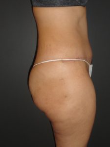 Abdominoplasty Case 10 in Scottsdale Arizona After Photos