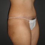 Abdominoplasty Case 10 in Scottsdale Arizona After Photos