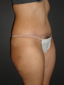 Abdominoplasty Case 10 in Scottsdale Arizona After Photos