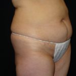 Before Abdominoplasty surgery Photos Case 11