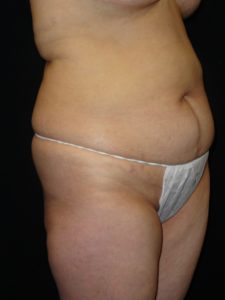 Before Abdominoplasty surgery Photos Case 11