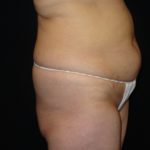 Before Abdominoplasty surgery Photos Case 11