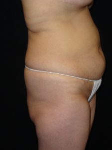 Before Abdominoplasty surgery Photos Case 11