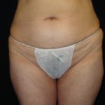 Before Abdominoplasty surgery Photos Case 11