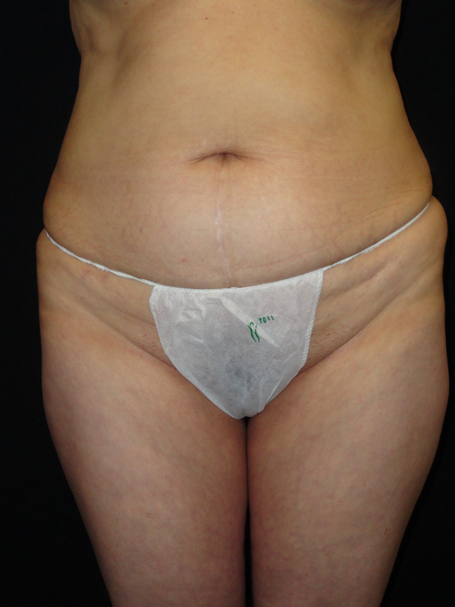 Before Abdominoplasty surgery Photos Case 11