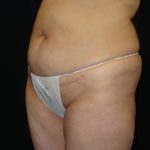 Before Abdominoplasty surgery Photos Case 11