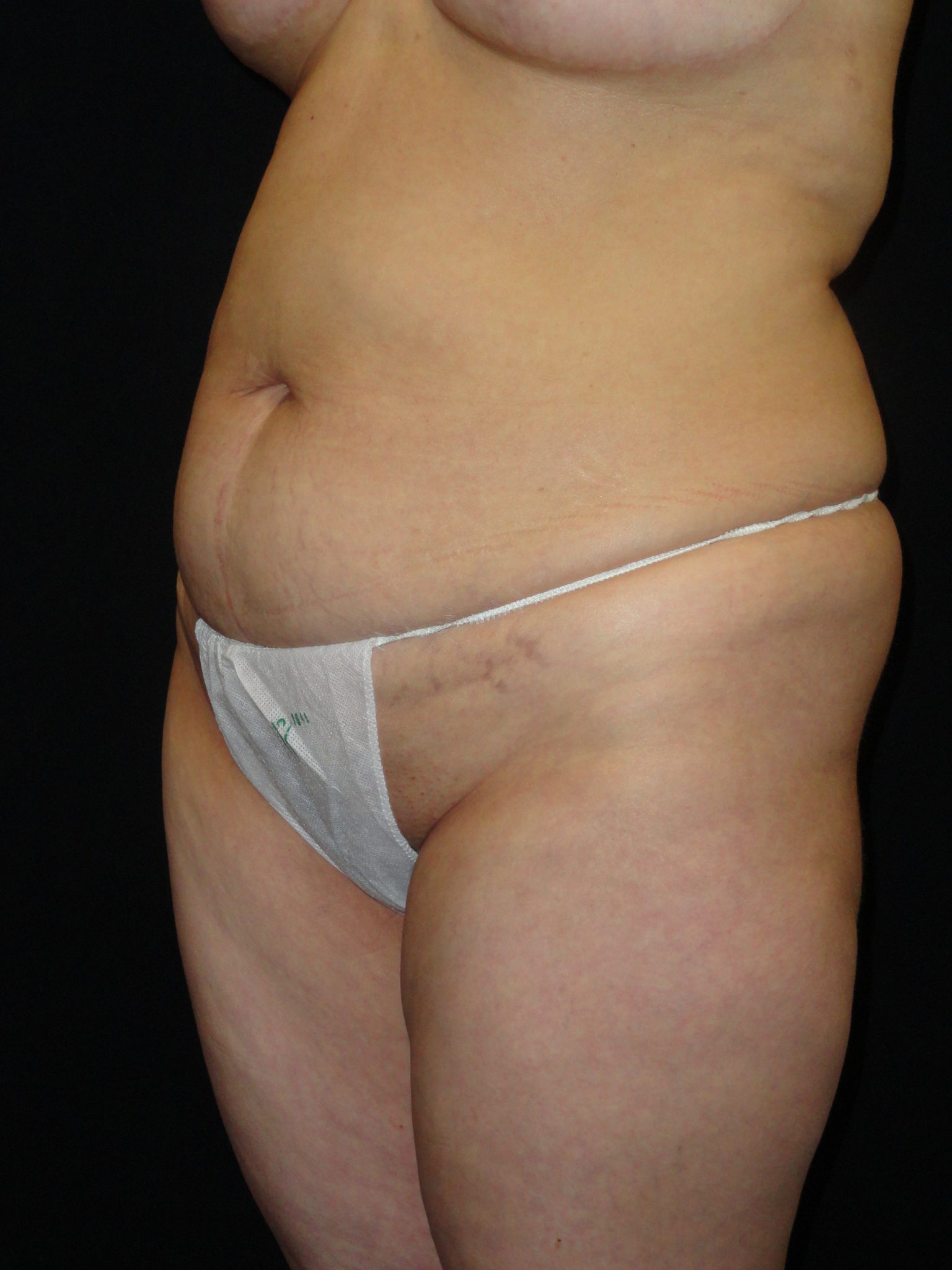 Before Abdominoplasty surgery Photos Case 11